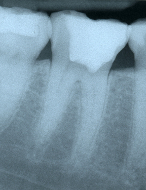 Calcified molar