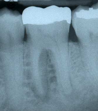 molar with bone loss mimicking root crack